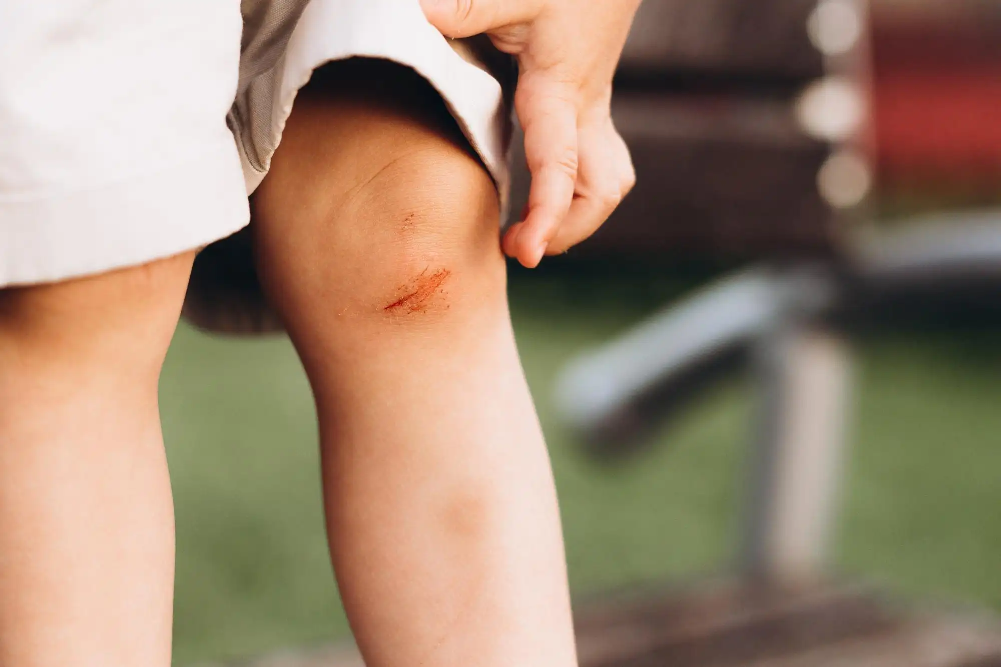 Child with a visible knee wound receiving care after an animal bite or insect sting.