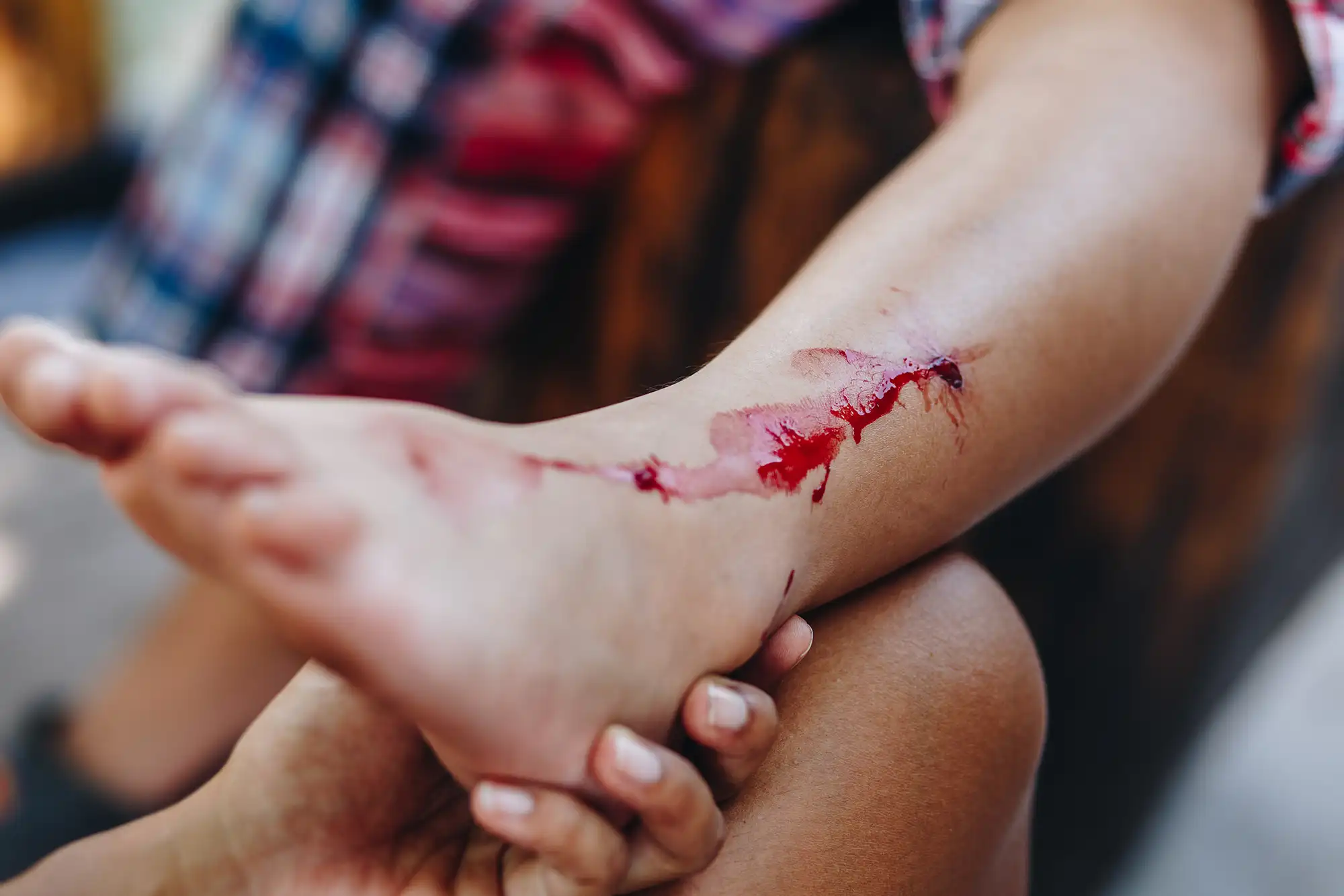 Child patient showing active leg bleeding from severe cuts and laceration injuries.
